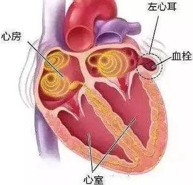 河南首例!一站式经导管主动脉瓣置换 左心耳封堵术