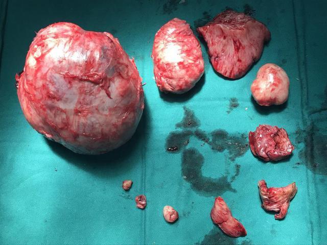 目前,治疗子宫肌瘤较好的方式是腹腔镜微创手术.