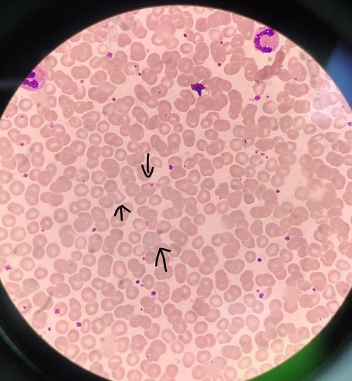 嗜多色性红细胞增多(油镜10×1000倍视野)