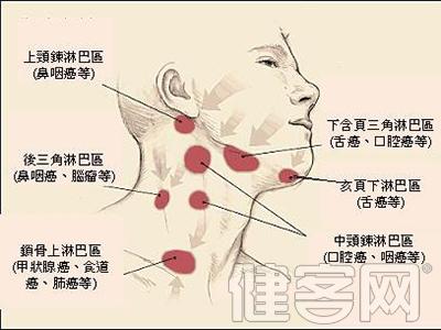 鼻咽癌:早期症状多在颈和耳