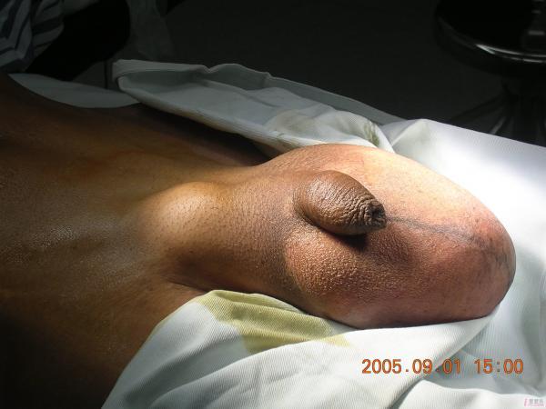 【原创】来一系列斜疝嵌顿后坏死机化的手术照片