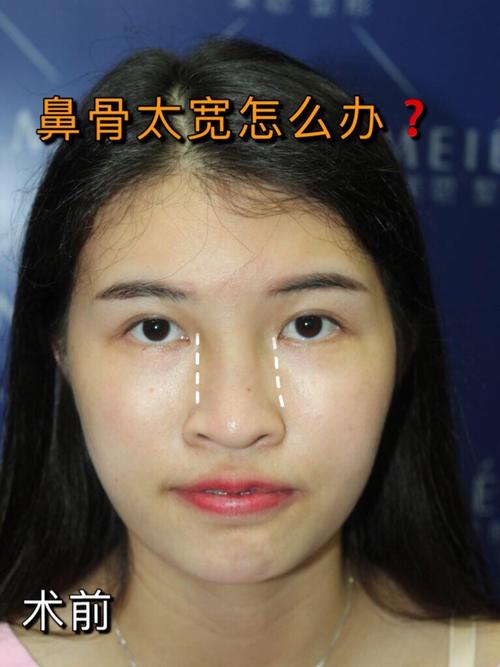 什么是鼻骨内推?