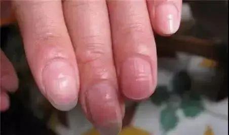 指甲长这样,竟是癌症的信号?出现这些"异样"可能已是