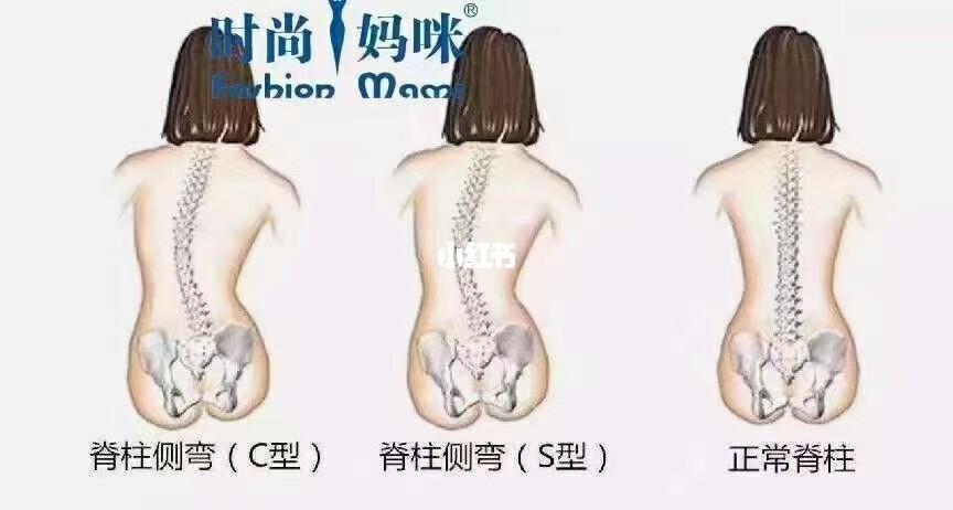 骨盆没有恢复好容易引起:1.腰痛,耻骨,臀部疼痛. 2.