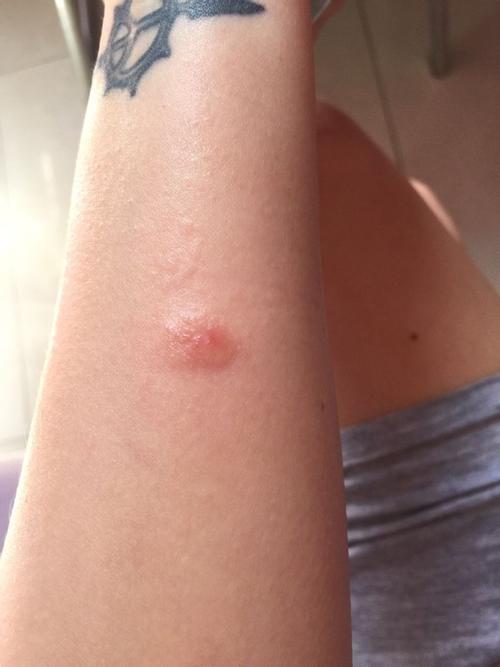 翅隐虫咬伤图片水泡