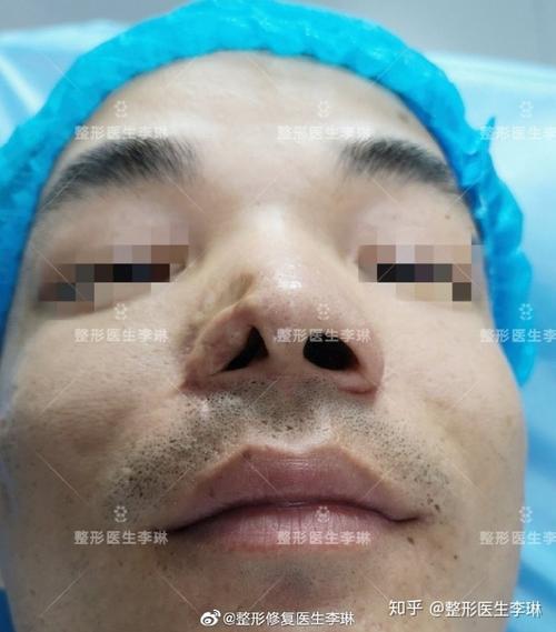 鼻翼再造术——男子幼年右鼻翼烧伤造成鼻翼缺损#李琳