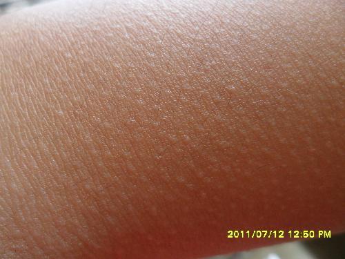 这是毛周角化症吗?