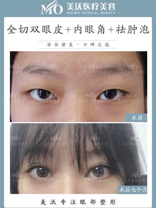 让眼睛没睁开的肿眼泡分哪几种?