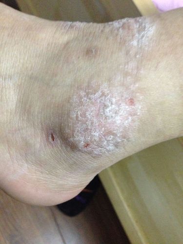 拐和脚踝拐都有这种皮肤病,其他皮肤上没有,也去医院了,看了是湿疹,开