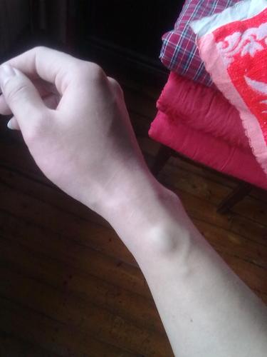 我26岁,左手手腕处一根静脉血管起了个小包,和血管同色,不硬,约1.