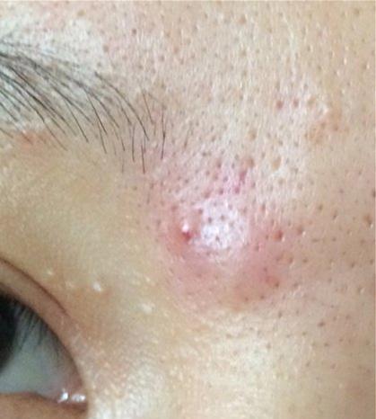 5,囊肿,在结节的基础上,发生在真皮或皮下组织含有液体或者半固体