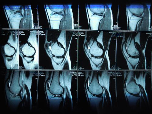 踢球受伤求助!请骨科专家来帮我看看我的左边膝盖核磁共振的片子!