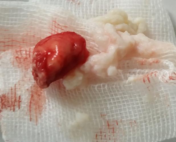 阴囊长粉瘤,切除免留后患.