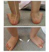 宝宝足外翻的治疗方法