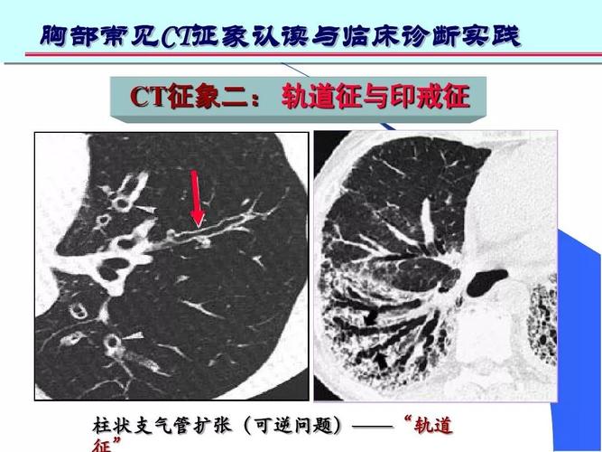 意义:  表明有支气管扩张,慢性支气管炎伴发的细支气管扩张等.