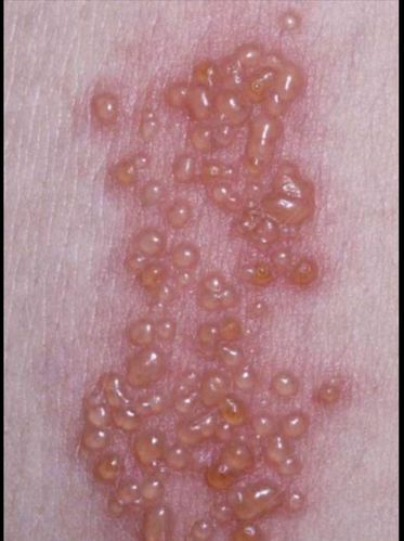 其它 带状疱疹 写美篇      带状疱疹是由水痘-带状疱疹病毒感染引起