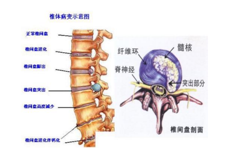 治疗腰椎间盘突的小药方,只需8毛钱,谁用谁说好!快分享给家人