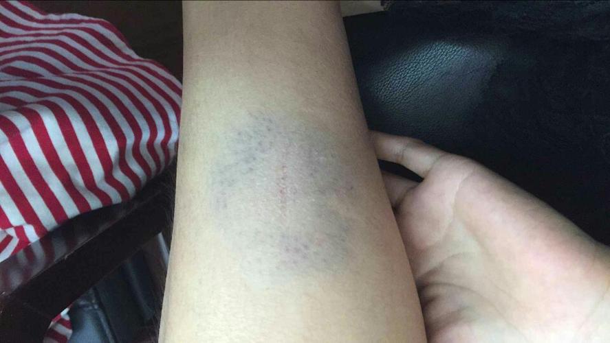 腿撞了下,想问问有什么方法消除下淤青和减少疼痛.