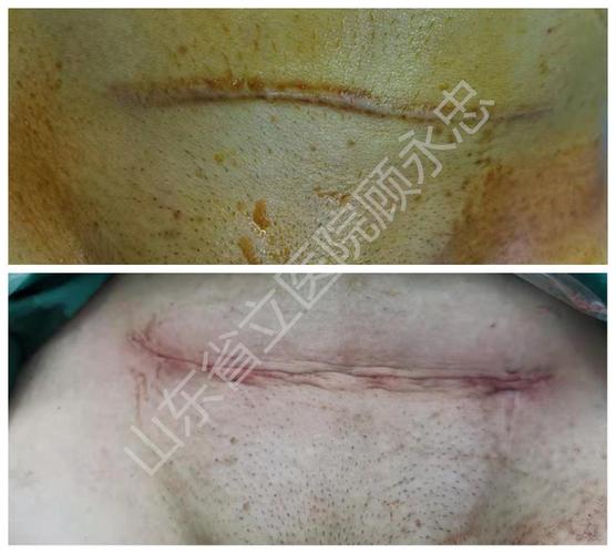 你笑起来真好看—剖宫产刀口_剖腹产 - 好大夫在线