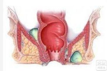 什么是肛门脓肿 通过图片全面认识肛门脓肿