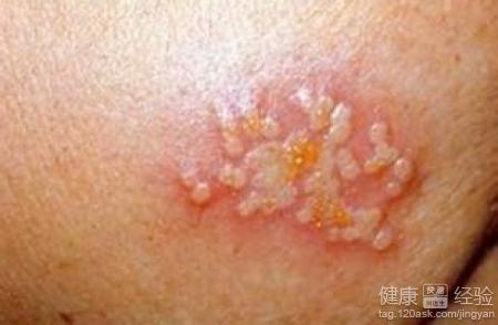 假性尖锐湿疣是怎么回事