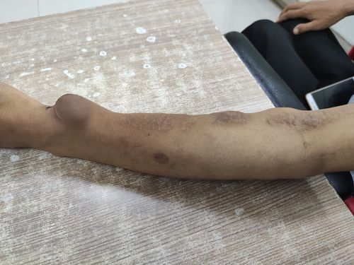 左前臂桡动脉-头静脉动静脉内瘘使用多年,近期出现内瘘吻合口处动脉瘤