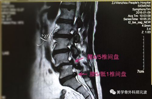 (腰4/5,腰5/骶1椎间盘严重突出伴腰4椎体滑移↑)(注:平时报告单上书写