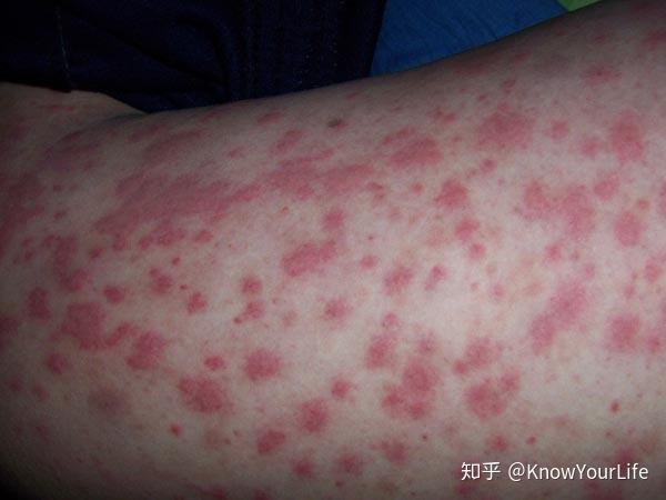 【史上最全医学科普9】让人口干舌燥的病--干燥综合征