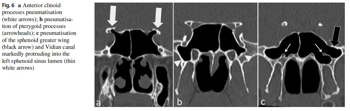 蝶窦:气化和解剖变异,放射科医生需要知道的