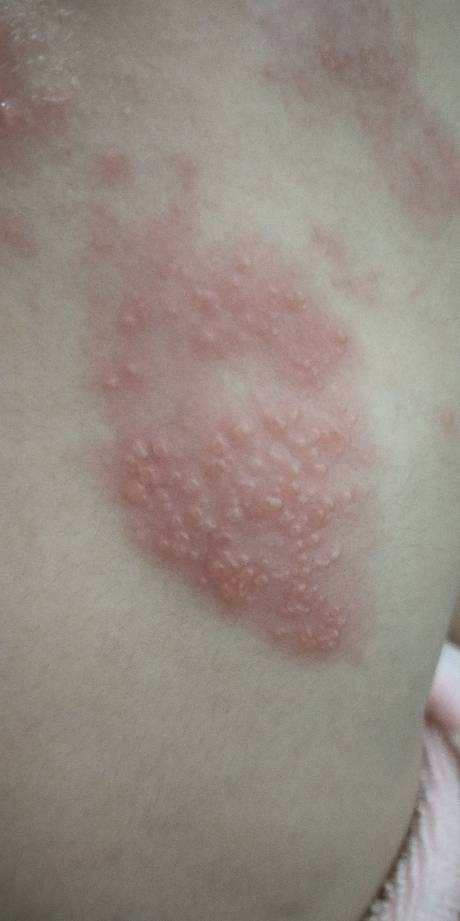 八岁小孩长了带状疱疹,涂了两天阿昔洛韦也不见好,好像还越来越多了