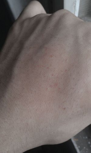 请问这是蜘蛛痣吗?会不会是有肝病?