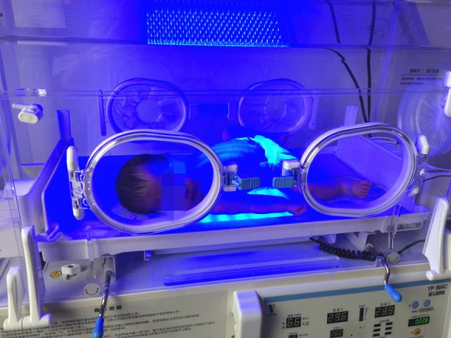 蓝光治疗让新生儿转危为安