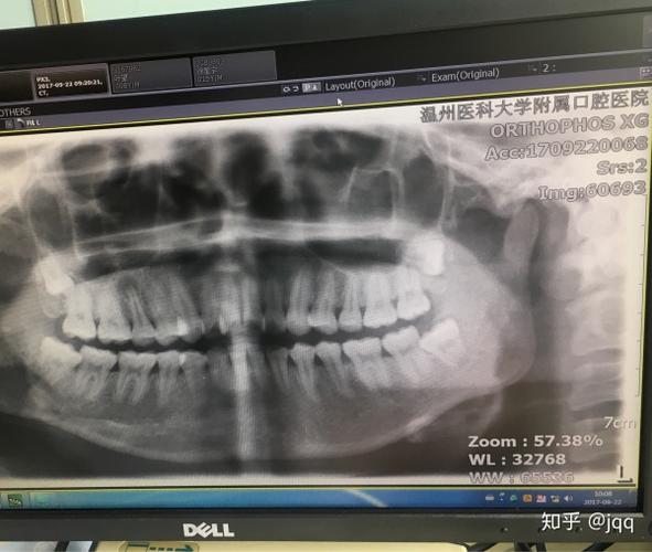 10.7 午 (拔右上5号牙)