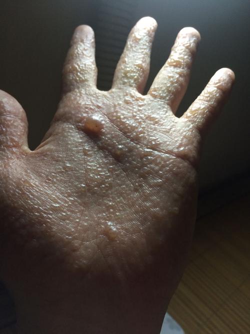 前一个星期手心开始发小水泡 慢慢的越来越多 我还患有过敏性紫癜 不