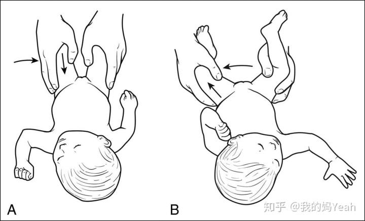 怀疑宝宝是ddh(发育性髋关节脱位),我们做了两次检查,也许还要第三次.