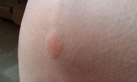 请问这些是被螨虫咬过吗?