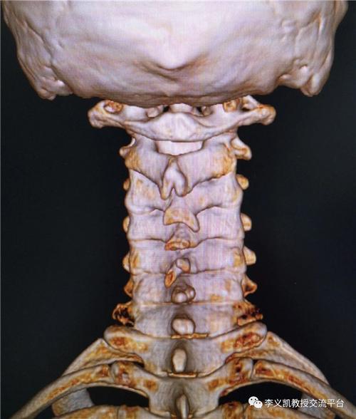 棘突偏歪和不对称很常见