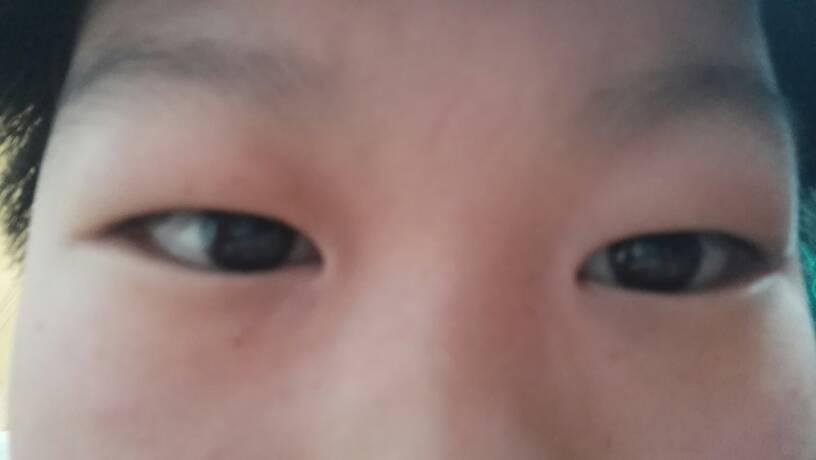 眼睛单眼皮鱼泡眼不动手术怎么变双眼皮?