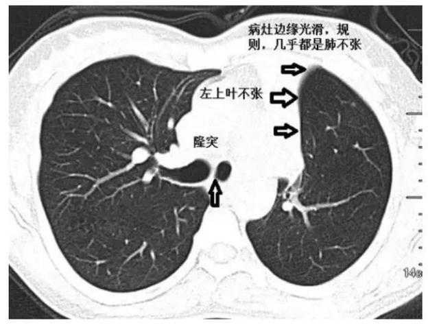 肺不张的影像学