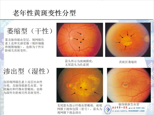 西安市第一医院:老年性(年龄相关性)黄斑变性