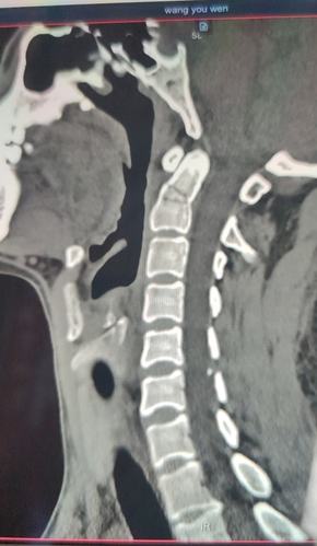 颈椎椎体ct 三维重建