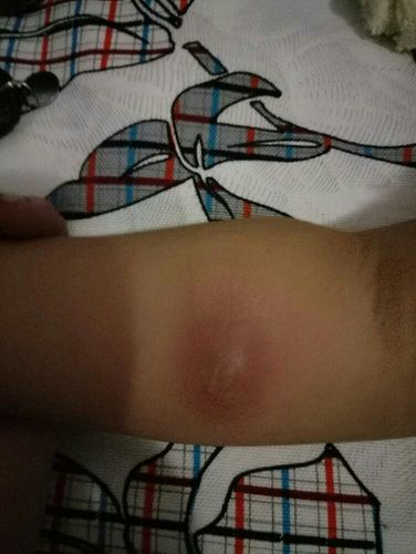 宝宝胳膊上长了一个火疖子怎么办