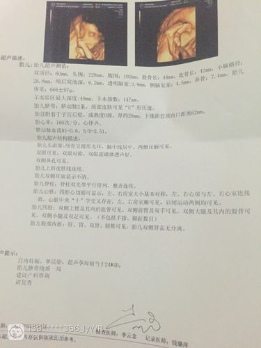 24周四维彩超归来,是男孩还是女孩呢