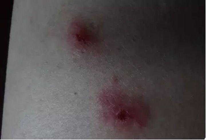 这些皮疹都是丘疹性荨麻疹.