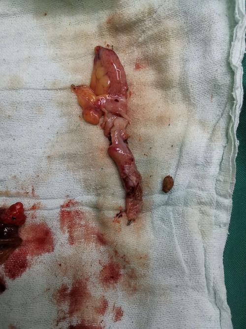 切除的阑尾及流出的粪石