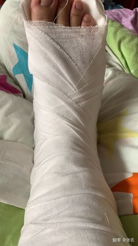 右脚第五趾骨骨折日记