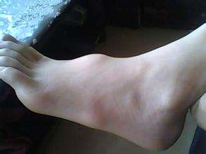 脚背腱鞘囊肿怎么治?这些方法非常成熟有效