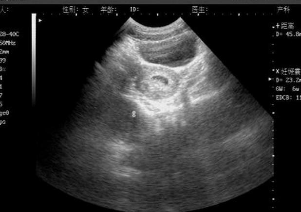 子宫内出现妊娠囊是超声诊断中最早期出现的现象,妊娠5周时可以出现