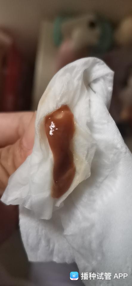 [试管婴儿]不知道是不是宫腔积液还没有排干