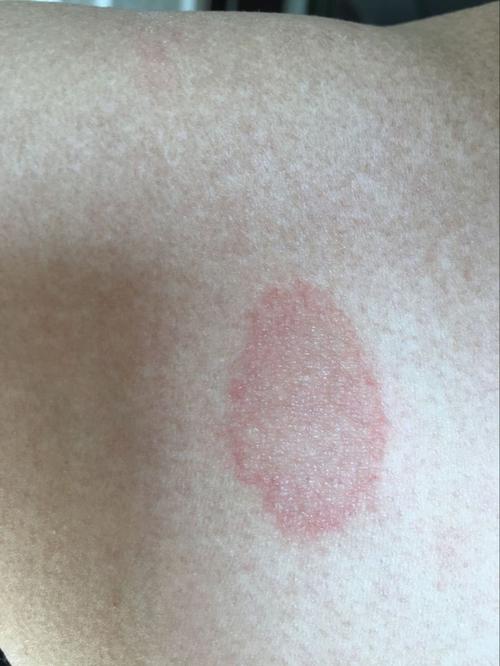 请问这个红色圆形斑是什么?急